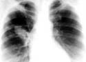 Radiografia de um pulmão