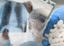 Médico vendo o raio-x do pulmão de um paciente com tuberculose