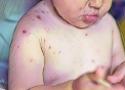 Desenho de um menino com monkeypox