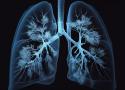 Raio-x de um pulmão infectado pela tuberculose mostra manchas escuras