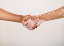 Foto de aperto de mãos entre uma pessoa sem vitiligo e outra com a doença